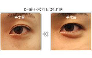 卧蚕前后对比照片,见证美丽蜕变之旅